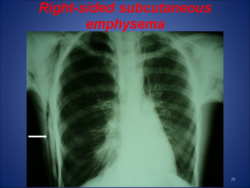 Right-sided subcutaneous emphysema  29